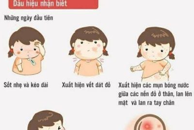 BÀI TUYÊN TRUYỀN PHÒNG CHỐNG BỆNH THỦY ĐẬU